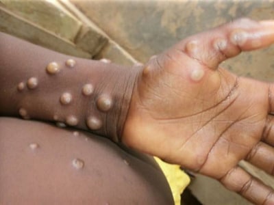 菲律宾卫生部将为猴痘病例设立隔离设施
